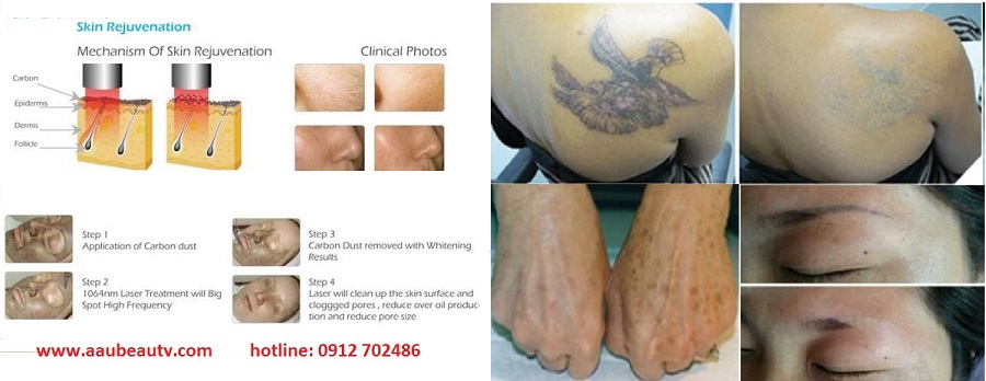 máy laser picosure xóa xăm